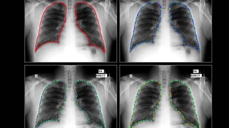 Chest Radiography Diagnosis for COVID-19